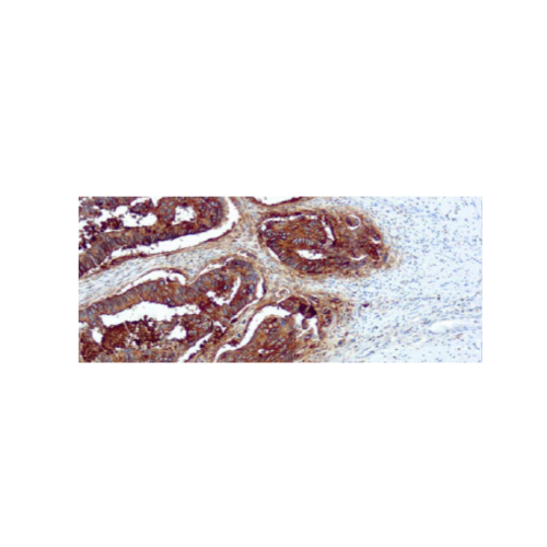 Antígeno Carcinoembrionario (CEA) Antígeno Carcinoembrionario (CEA)