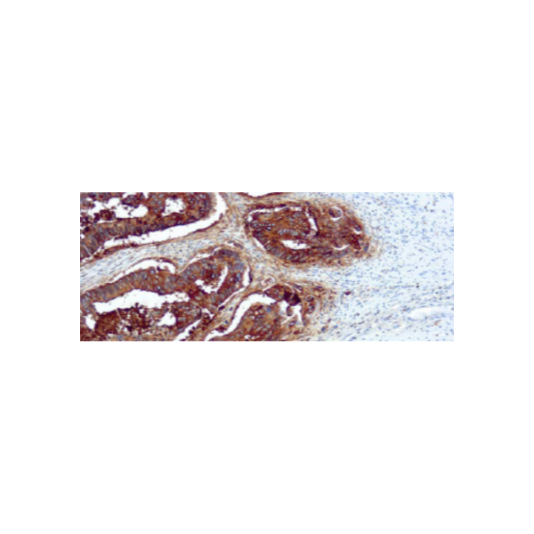 Antígeno Carcinoembrionario (CEA)