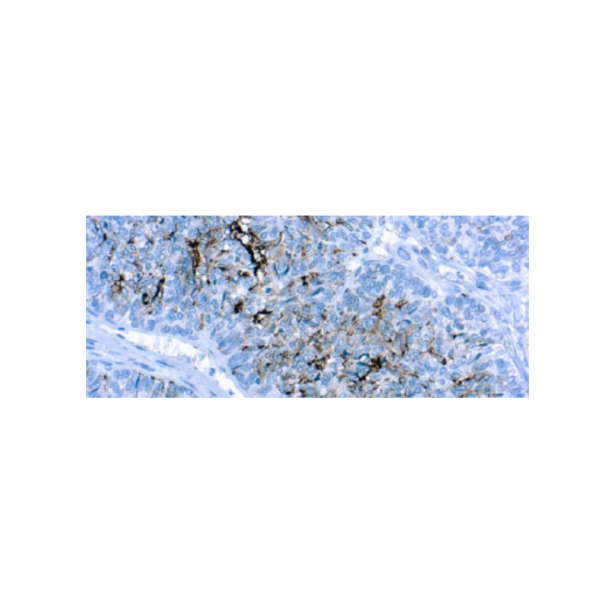 CA125 CA125