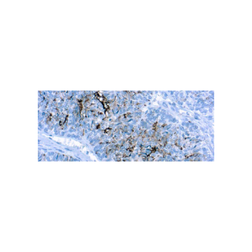 CA125 CA125