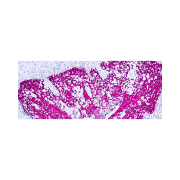 Citoqueratina, alto peso molecular
