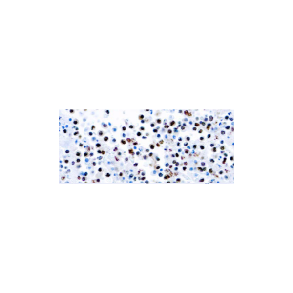 Herpesvirus 8 (HHV8) Herpesvirus 8 (HHV8)