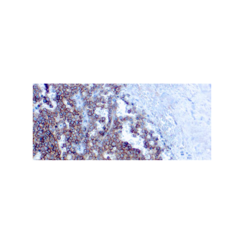 CD99MIC2, Ewing´s Sarcoma Marker CD99MIC2, Ewing´s Sarcoma Marker