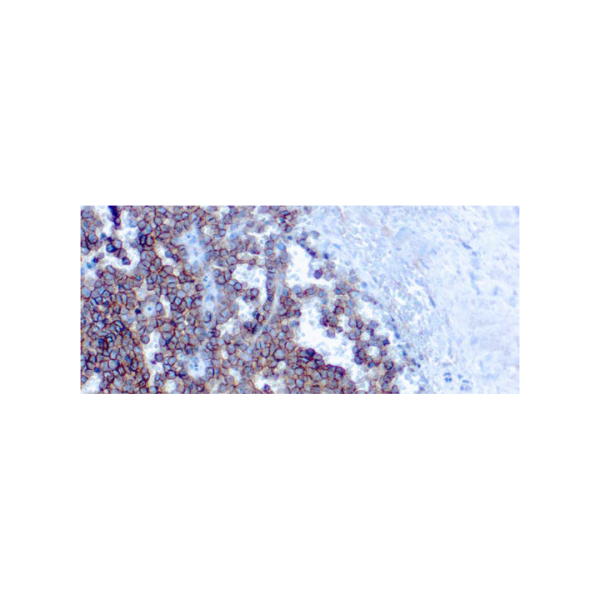 CD99MIC2, Ewing´s Sarcoma Marker CD99MIC2, Ewing´s Sarcoma Marker