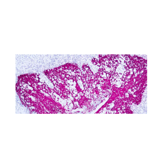 Citoqueratina, alto peso molecular