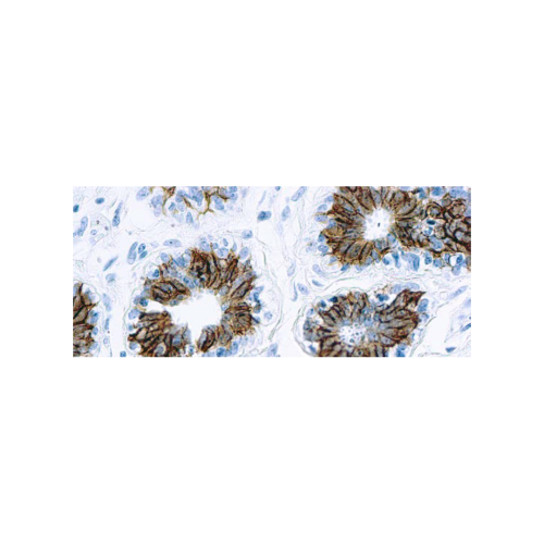 Epithelial Antigen (Ber-EP4) Epithelial Antigen (Ber-EP4)