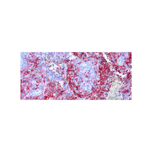 Melanoma (HMB45) Melanoma (HMB45)