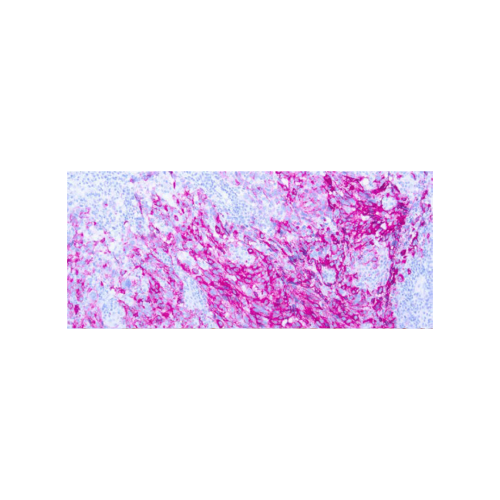 Melanoma (PNL2) Melanoma (PNL2)