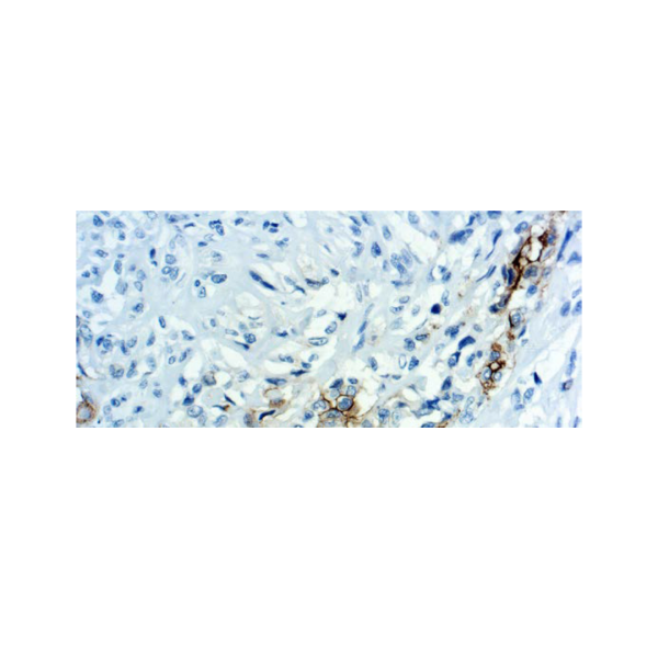 Mesothelin Mesothelin