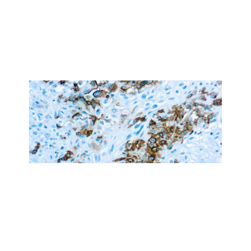 Mesothelioma