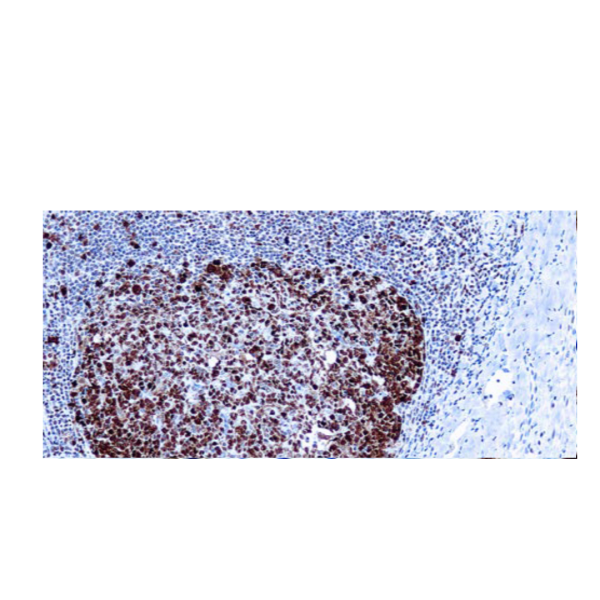 Proliferating Cell Nuclear Antigen