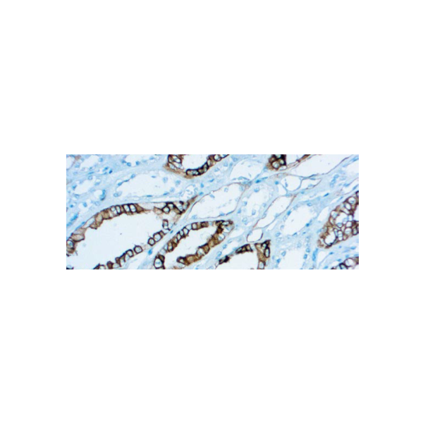 Renal Cell Carcinoma (gp200) Renal Cell Carcinoma (gp200)