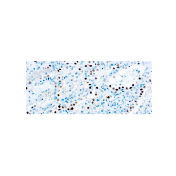 Thyroid Transcription Factor‐1, TTF‐1, Thyroid Transcription Factor‐1, TTF‐1,