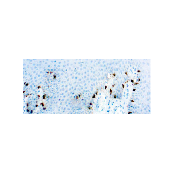 Tyrosinase, Melanoma Marker